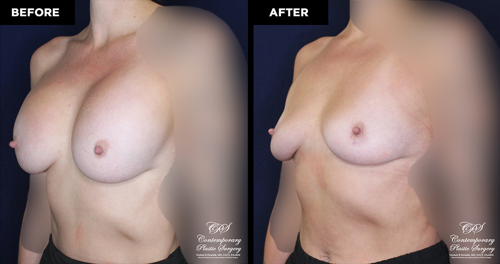 breast implant removal without replacement at Contemporary Plastic Surgery