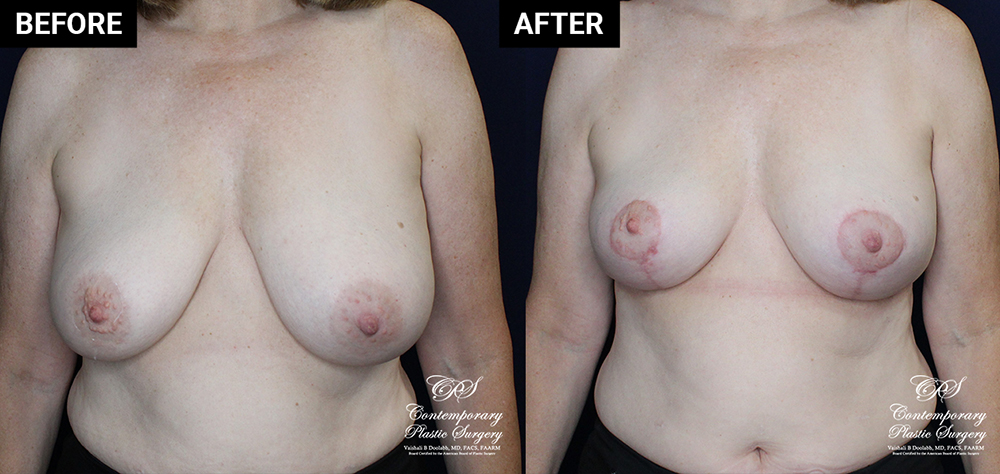 breast lift patient results at Contemporary Plastic Surgery