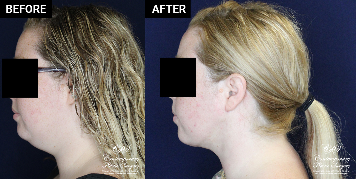 chin liposuction patient results at Contemporary Plastic Surgery