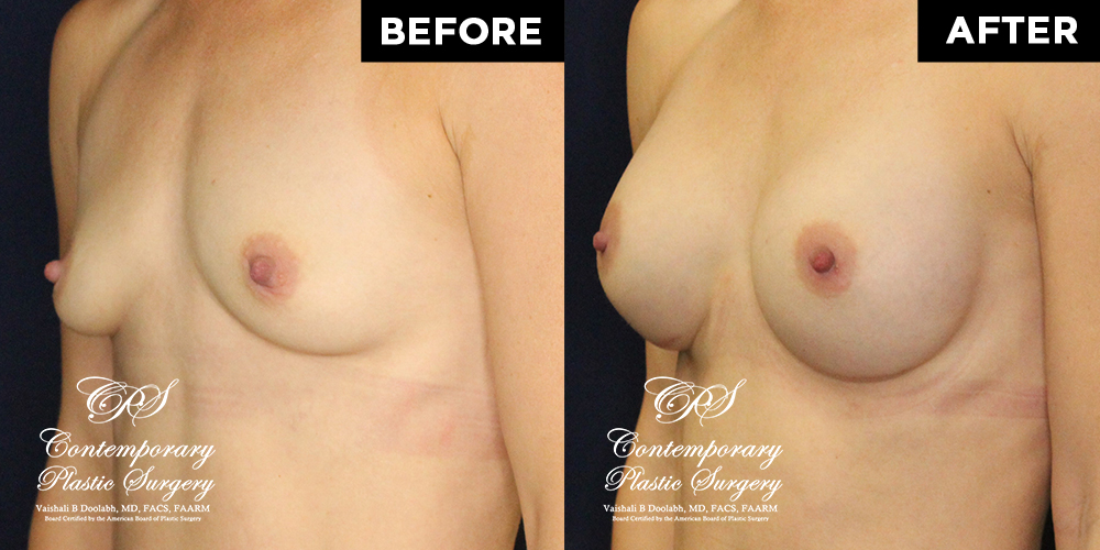 Patient #15507’s Breast Augmentation at Jacksonville plastic surgery clinic, Contemporary Plastic Surgery
