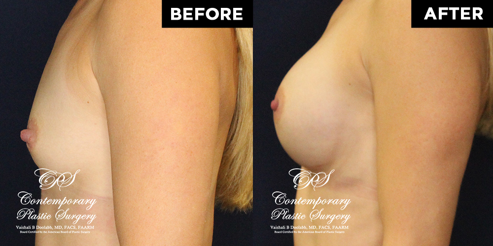 Patient #15507’s Breast Augmentation at Jacksonville plastic surgery clinic, Contemporary Plastic Surgery