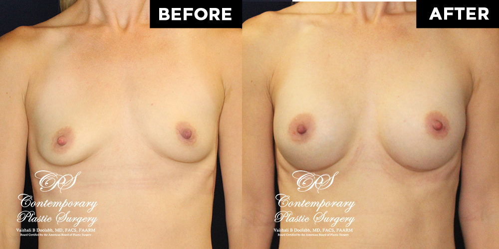 Patient #15507’s Breast Augmentation at Jacksonville plastic surgery clinic, Contemporary Plastic Surgery