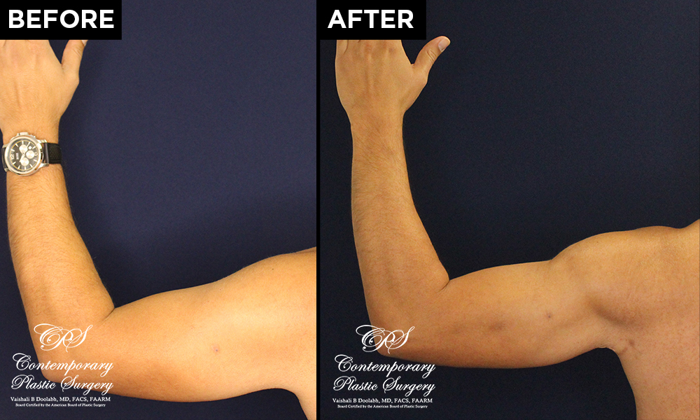 body contouring before and after patient results at Contemporary Plastic Surgery