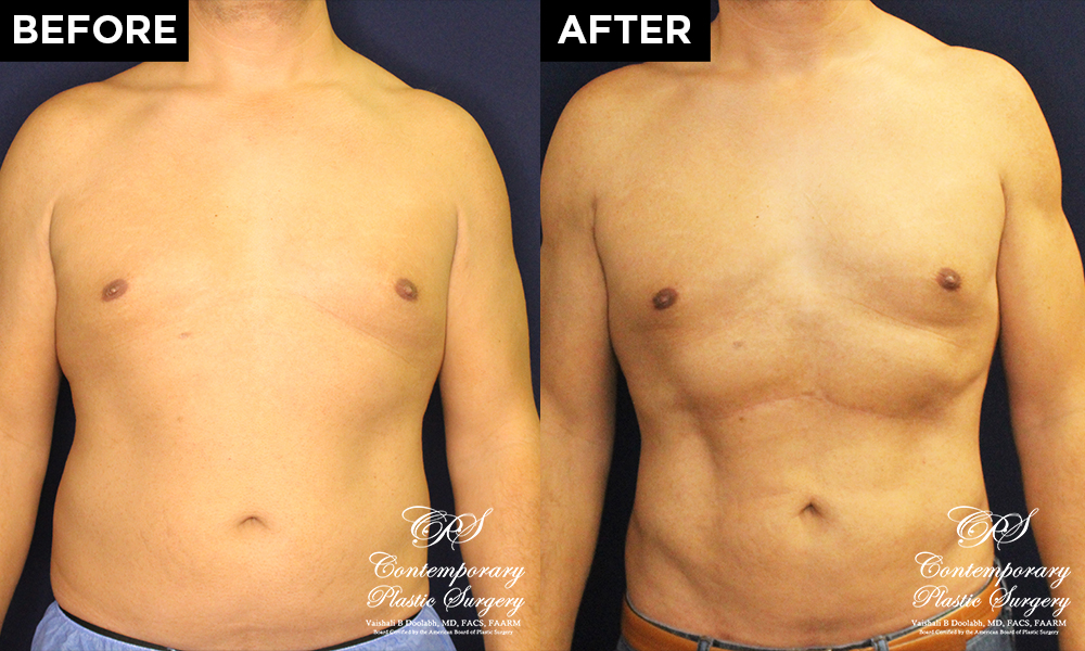 body contouring before and after patient results at Contemporary Plastic Surgery