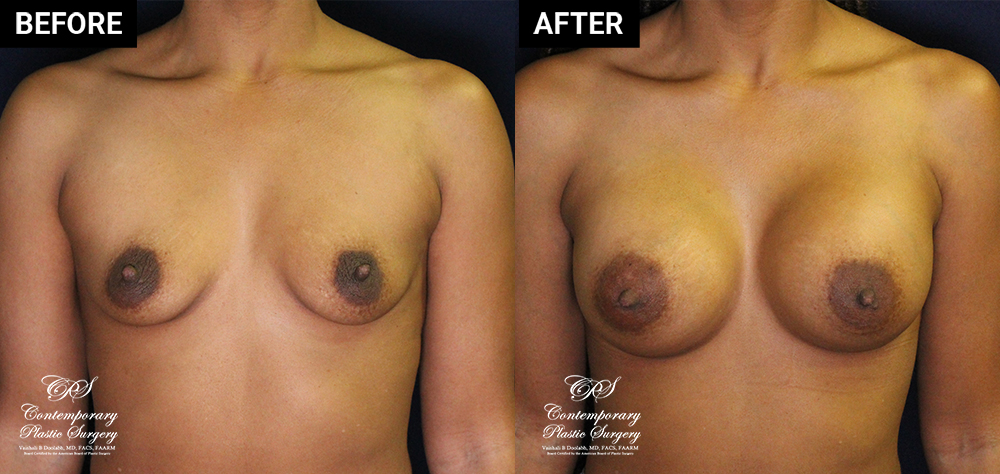 breast augmentation patient before and after result at Contemporary Plastic Surgery