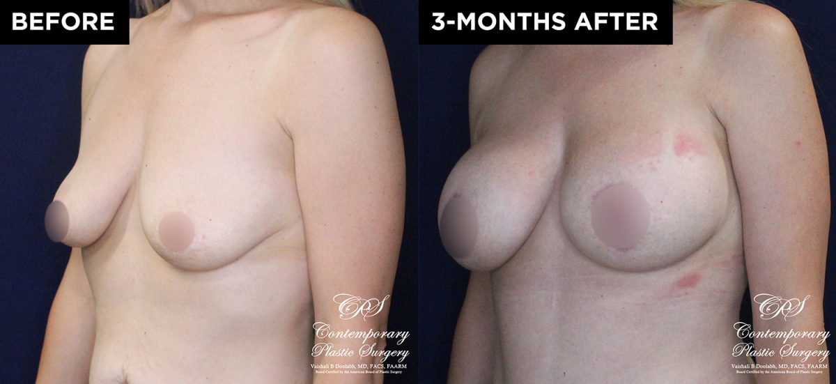 patient 15895 breast augmentation results at Contemporary Plastic Surgery