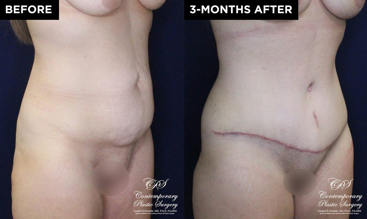 patient 15895 tummy tuck results at Contemporary Plastic Surgery