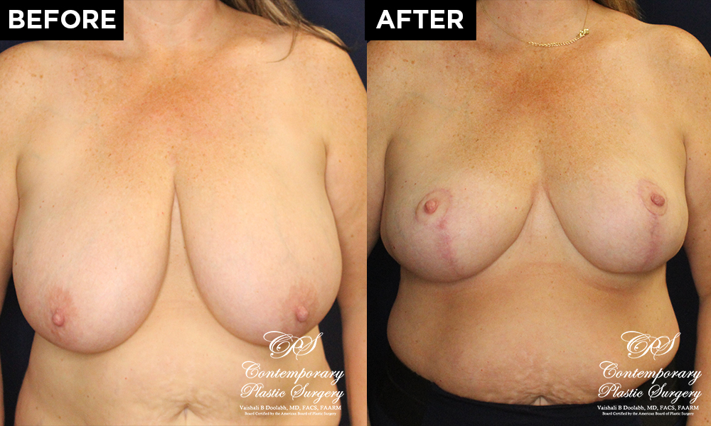 breast reduction patient results at Contemporary Plastic Surgery