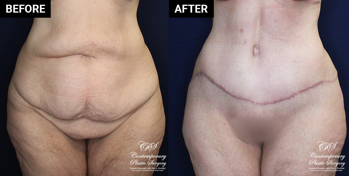 tummy tuck patient results at Contemporary Plastic Surgery