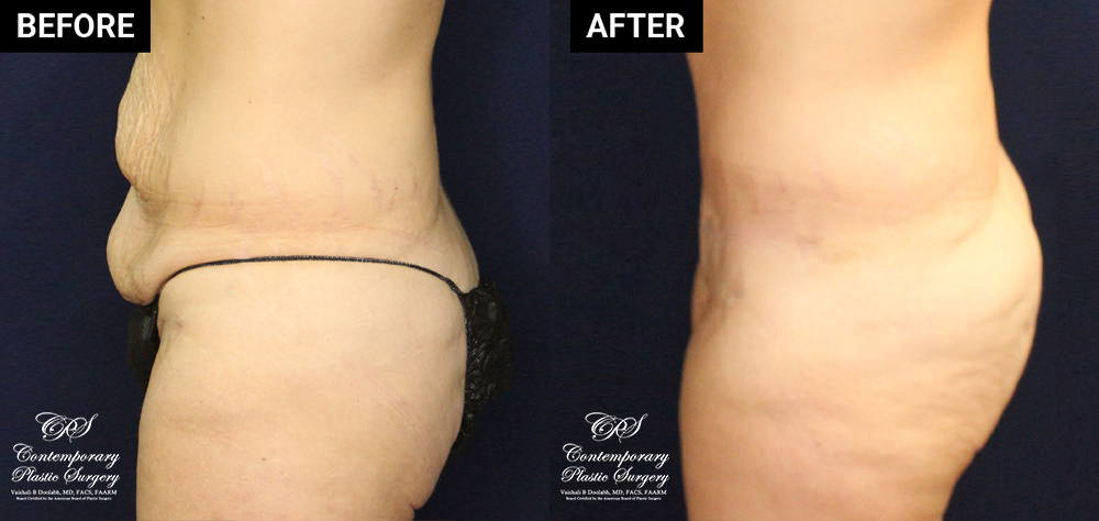 tummy tuck patient before and after results at Contemporary Plastic Surgery