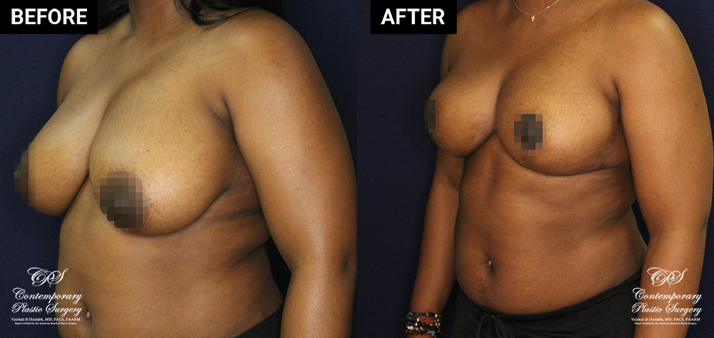 breast lift and liposuction patient before and after results at Contemporary Plastic Surgery