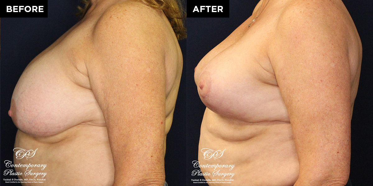 breast reduction surgery