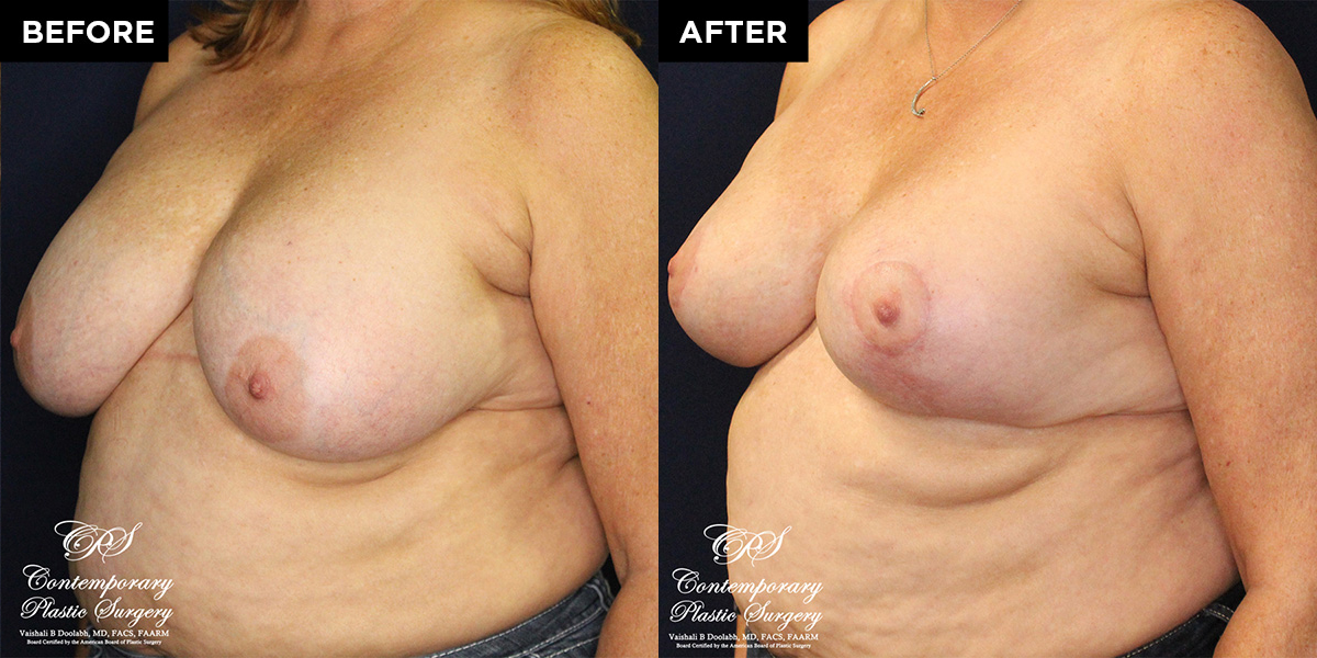 breast reduction surgery