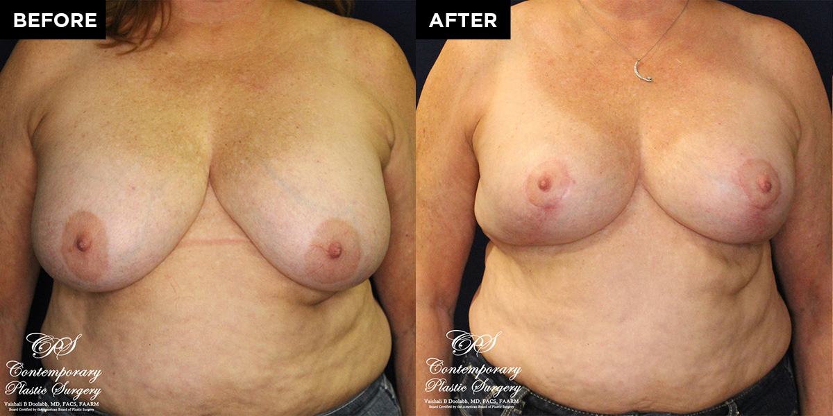 breast reduction surgery