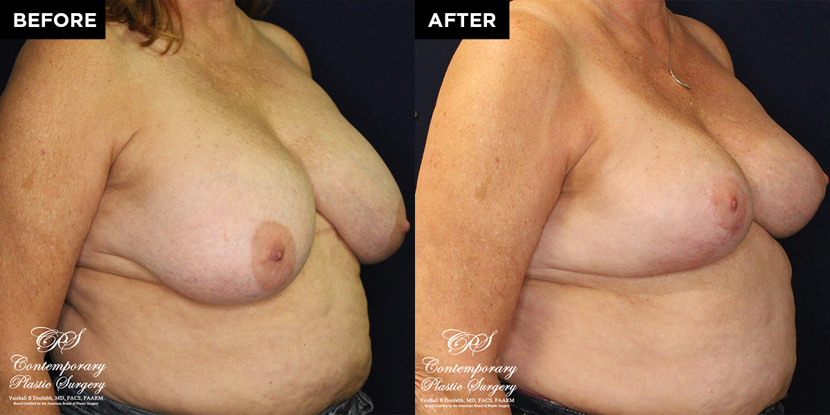 breast reduction surgery