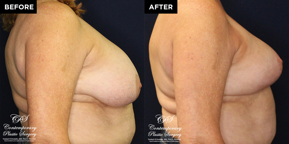 breast reduction surgery