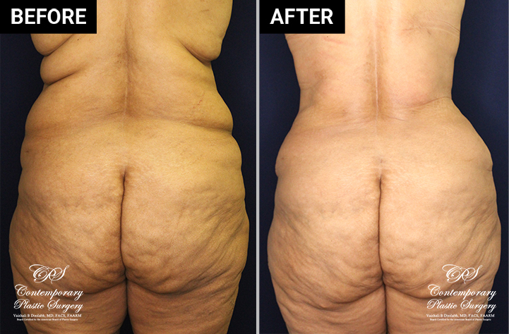 tummy tuck and liposuction patient results at Contemporary Plastic Surgery