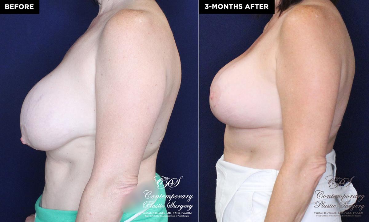 patient 16673's before and after results from a breast implant exchange and breast reduction with a lift at Contemporary Plastic Surgery