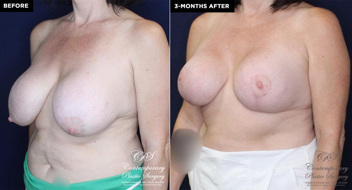 patient 16673's before and after results from a breast implant exchange and breast reduction with a lift at Contemporary Plastic Surgery