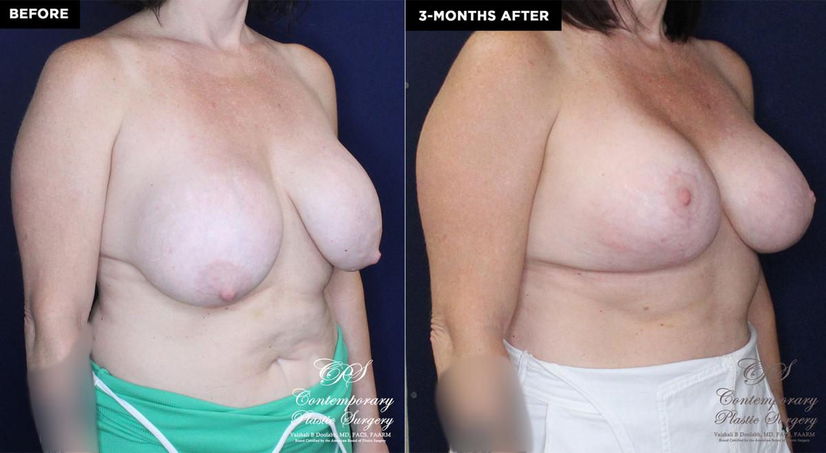 patient 16673's before and after results from a breast implant exchange and breast reduction with a lift at Contemporary Plastic Surgery