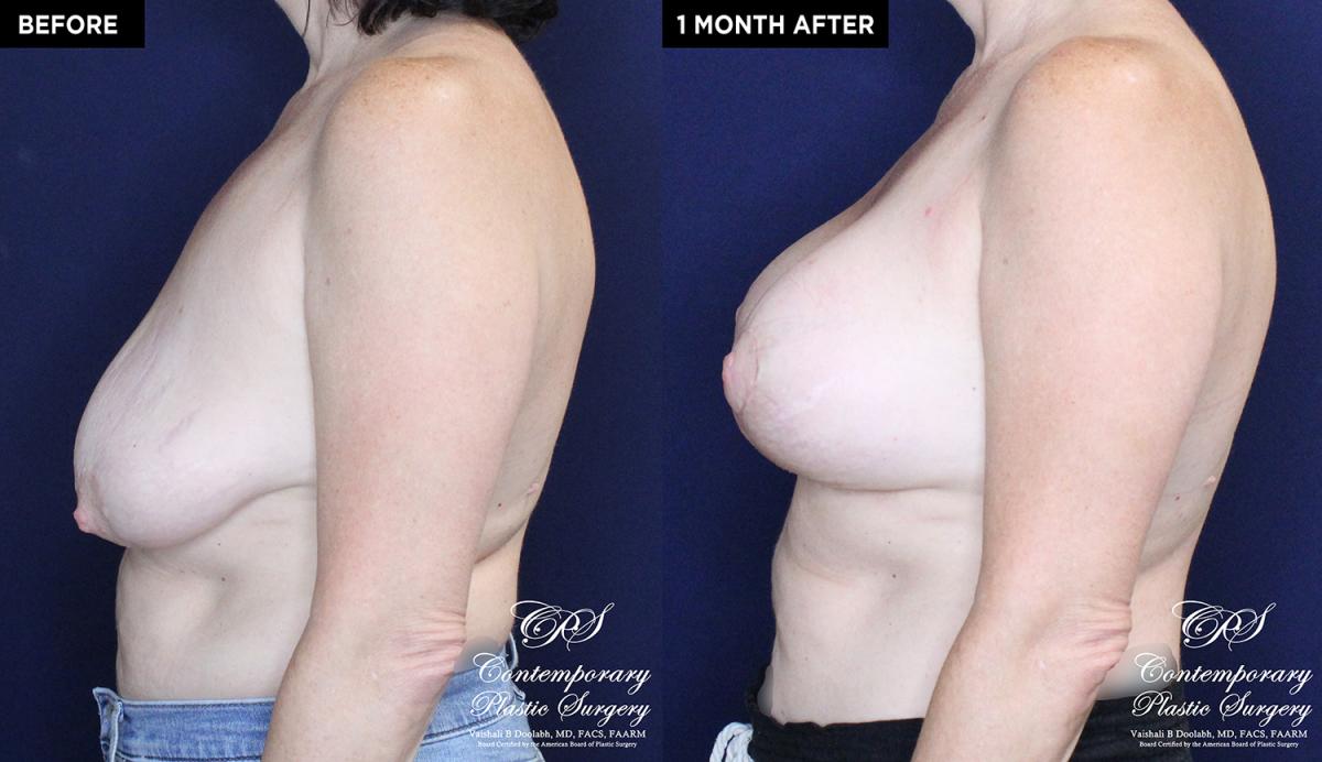 Patient 16673 breast surgery with implants before and after results at Contemporary Plastic Surgery