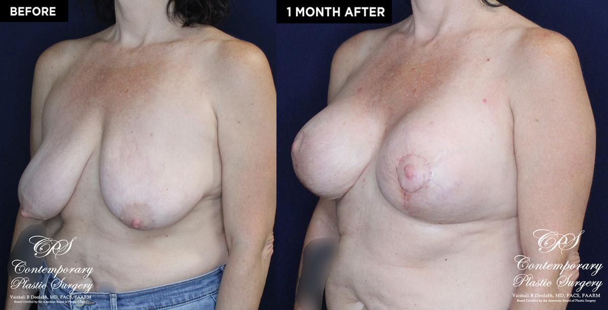 Patient 16673 breast surgery with implants before and after results at Contemporary Plastic Surgery