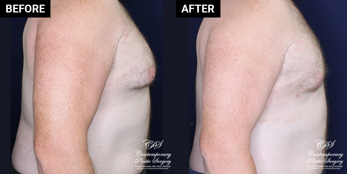 Male breast reduction results at Contemporary Plastic Surgery