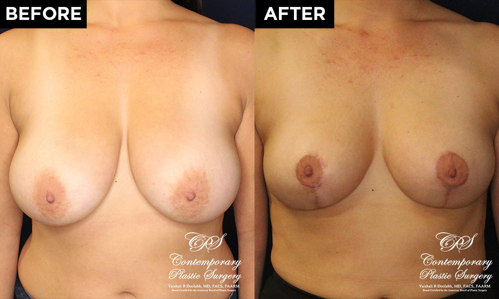 breast reduction and breast lift before and after results at Contemporary Plastic Surgery