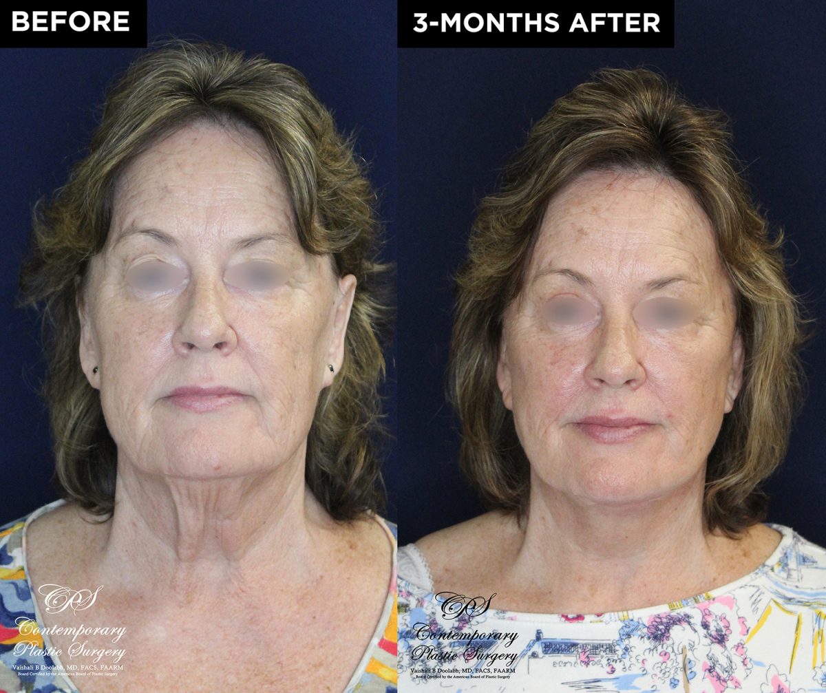 lower face and neck lift with upper eyelid lift before and after results at Contemporary Plastic Surgery
