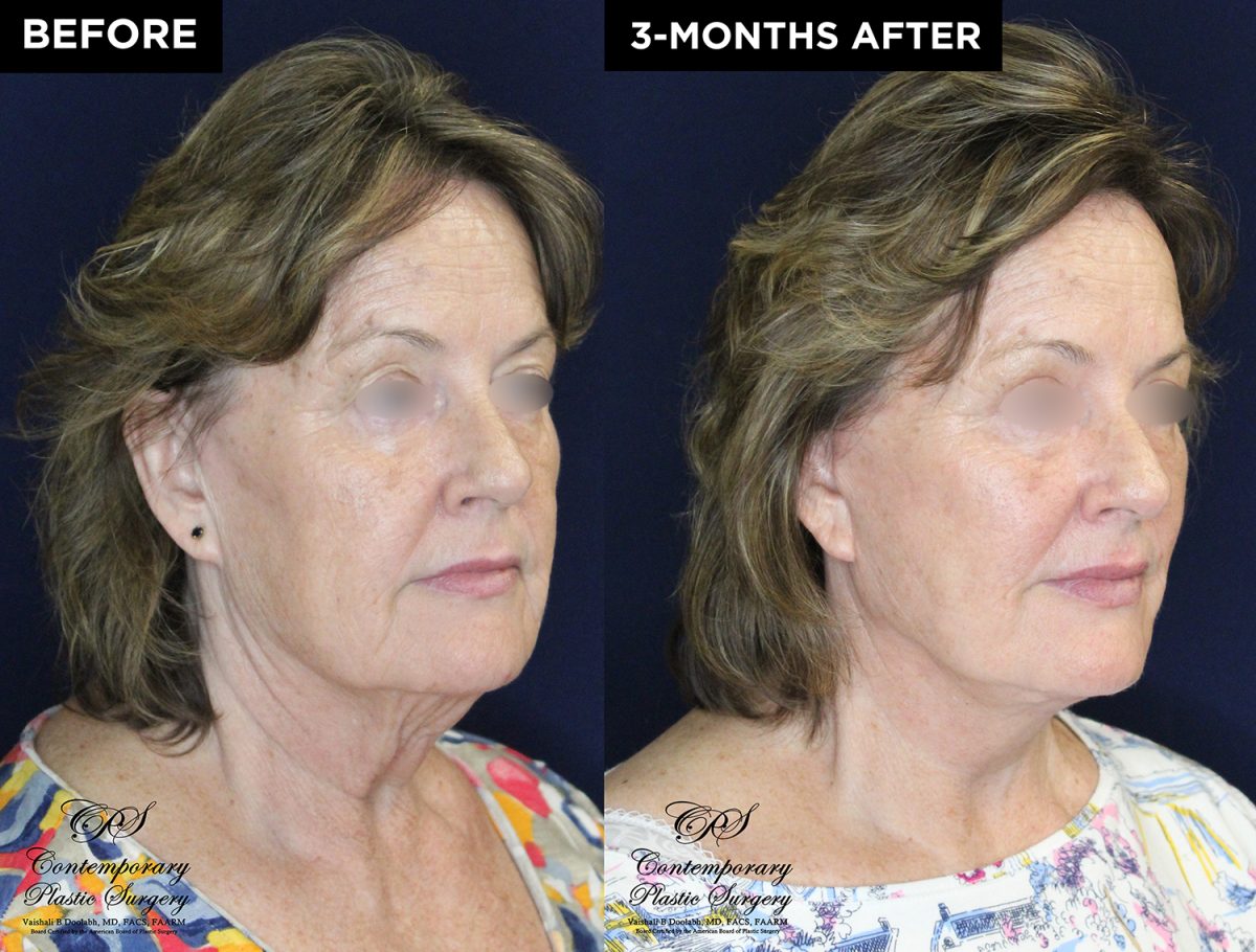 lower face and neck lift with upper eyelid lift before and after results at Contemporary Plastic Surgery