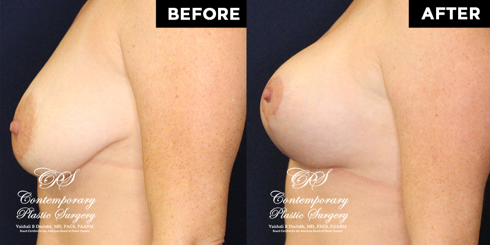 Patient #17646’s Breast Lift before and after at Jacksonville plastic surgery clinic, Contemporary Plastic Surgery