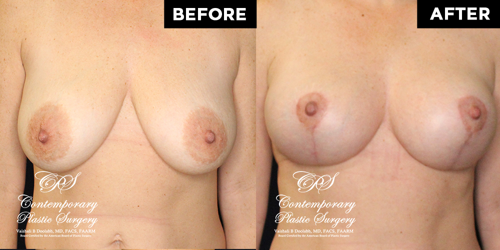 Patient #17646’s Breast Lift before and after at Jacksonville plastic surgery clinic, Contemporary Plastic Surgery