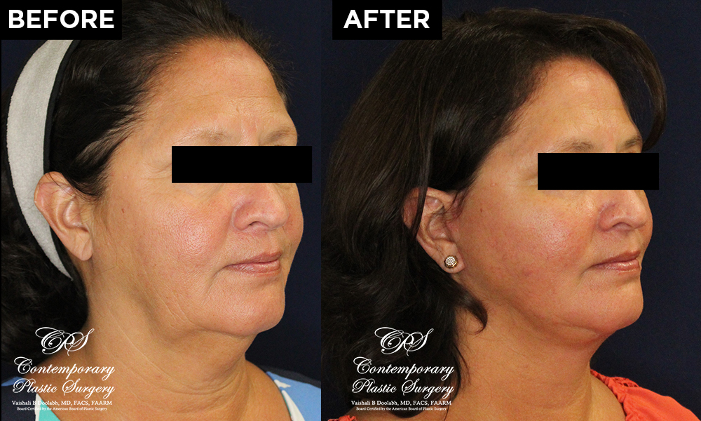 face and neck lift patient results at Contemporary Plastic Surgery