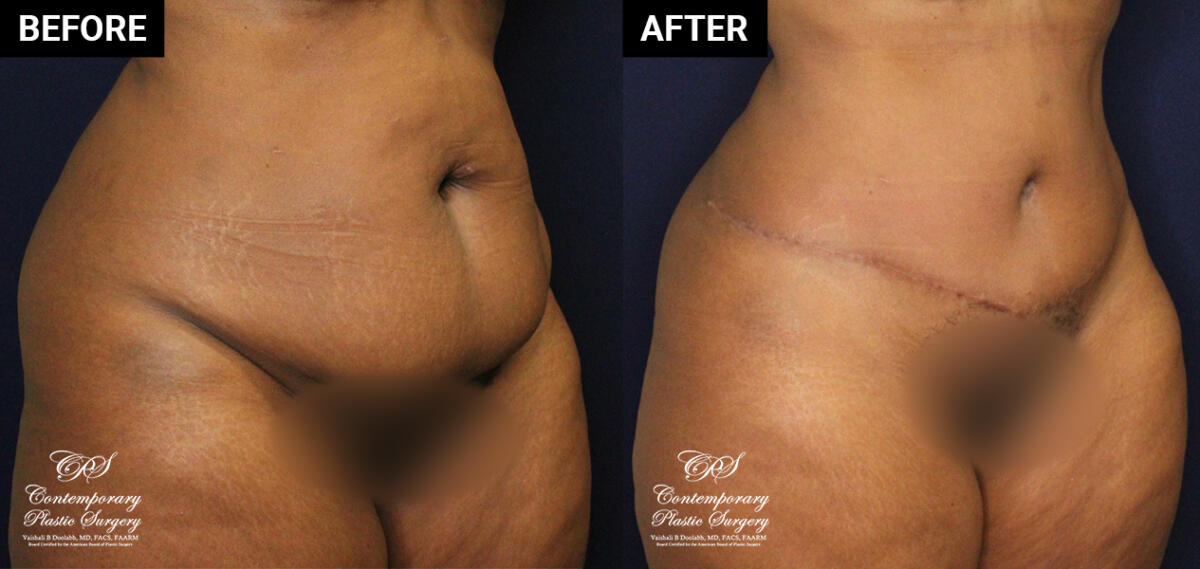 Tummy tuck patient before and after results at Contemporary Plastic Surgery