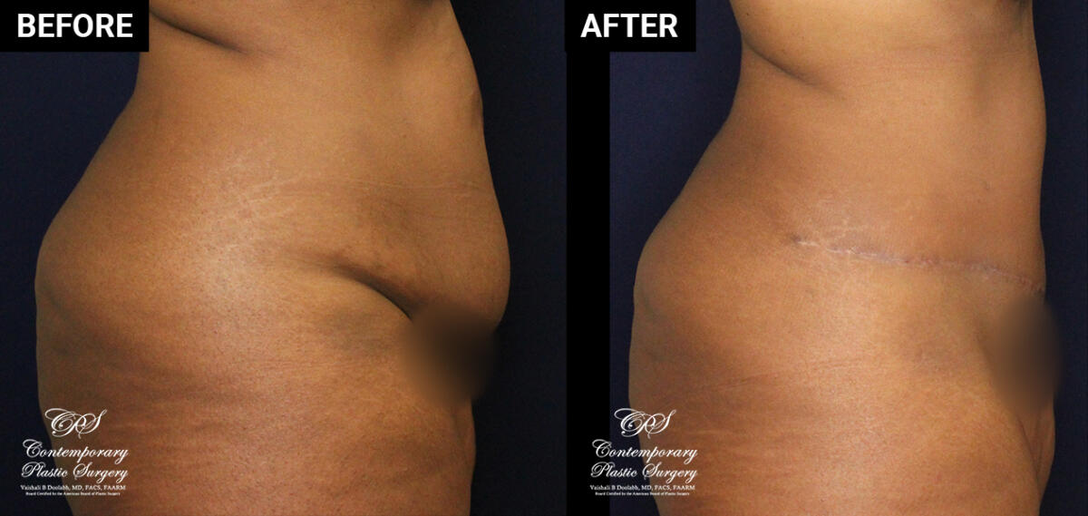 Tummy tuck patient before and after results at Contemporary Plastic Surgery