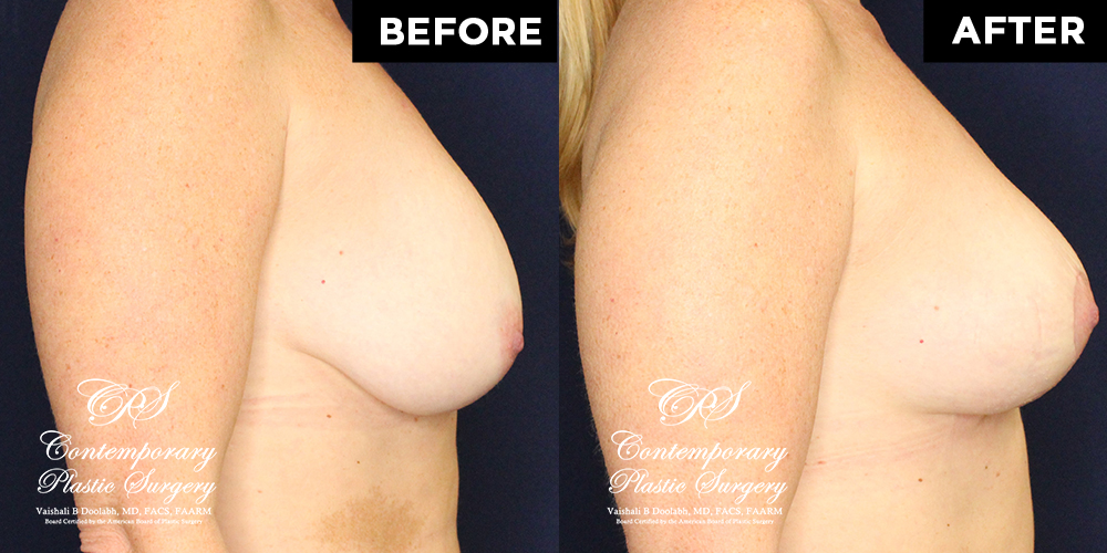 Patient #17994’s Breast Lift before and after at Jacksonville plastic surgery clinic, Contemporary Plastic Surgery