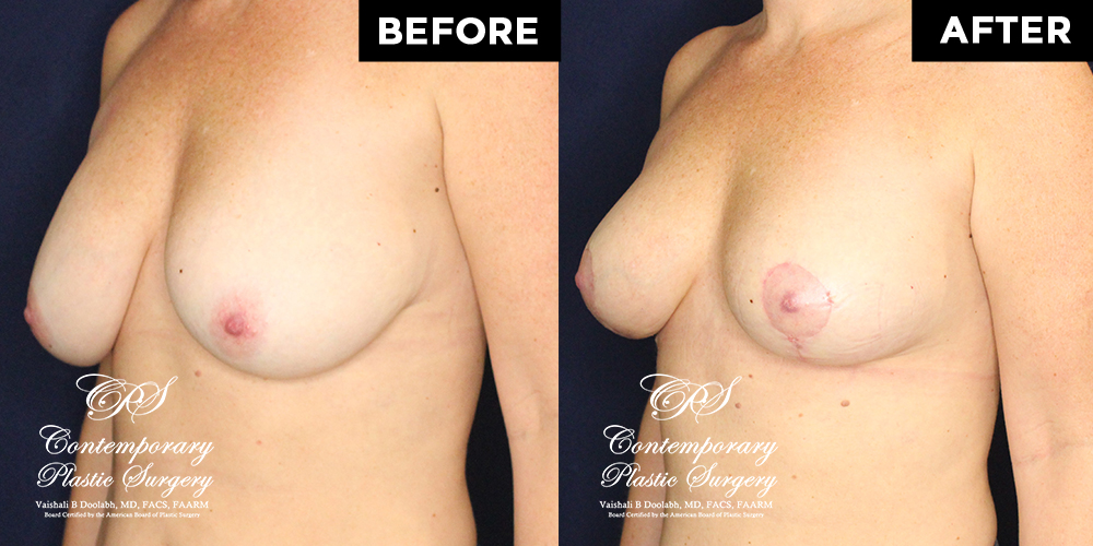 Patient #17994’s Breast Lift before and after at Jacksonville plastic surgery clinic, Contemporary Plastic Surgery