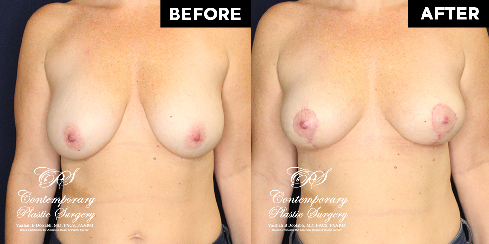 Patient #17994’s Breast Lift before and after at Jacksonville plastic surgery clinic, Contemporary Plastic Surgery