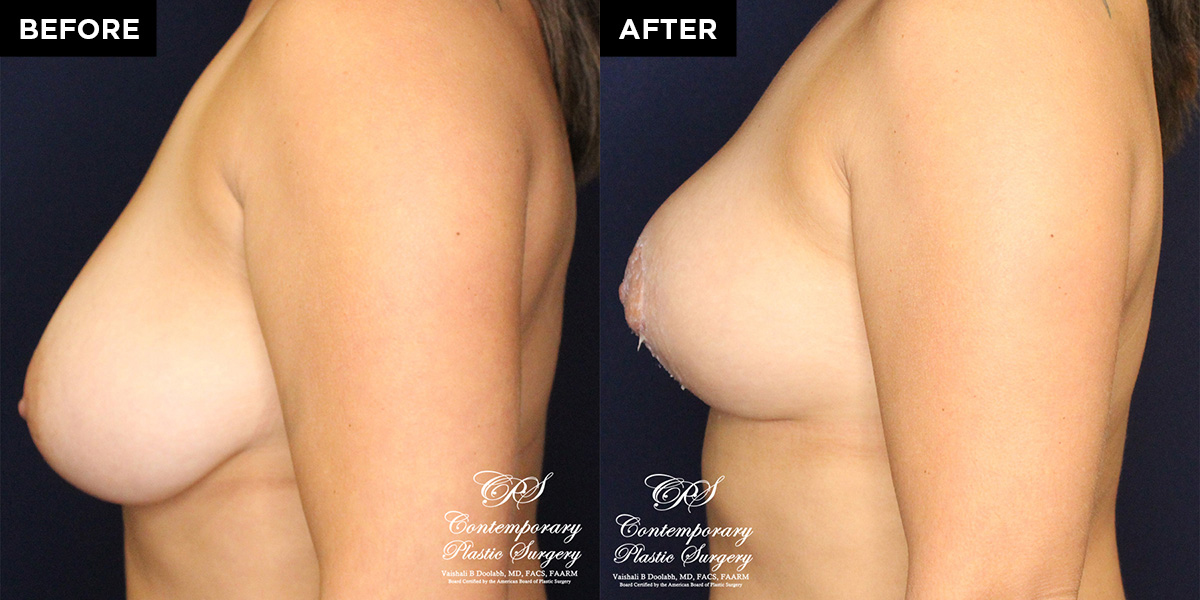 breast reduction surgery