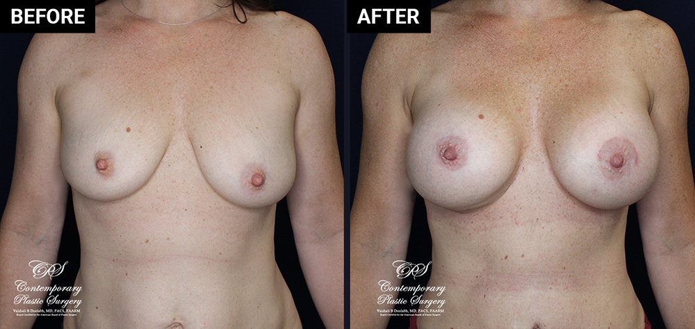 breast augmentation patient results at Contemporary Plastic Surgery