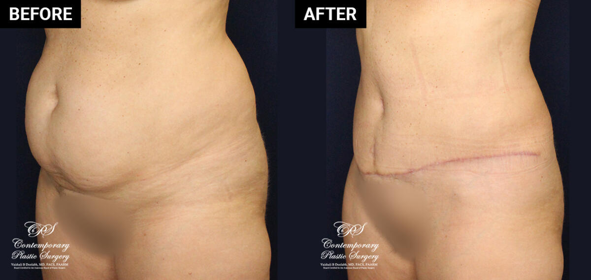 Tummy tuck patient surgery results at Contemporary Plastic Surgery