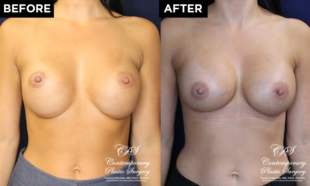 implant pocket tightening before and after results at Contemporary Plastic Surgery