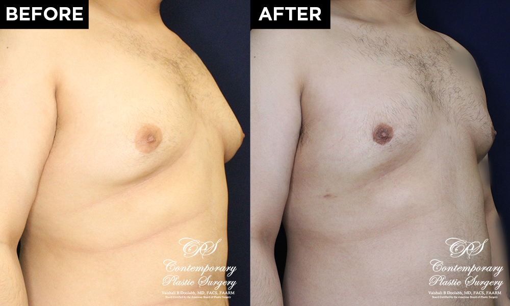 liposuction before and after results at Contemporary Plastic Surgery
