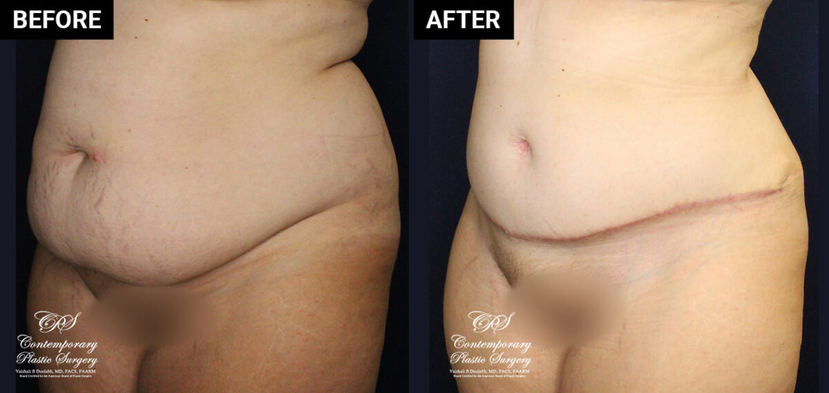 Tummy tuck patient surgery results at Contemporary Plastic Surgery