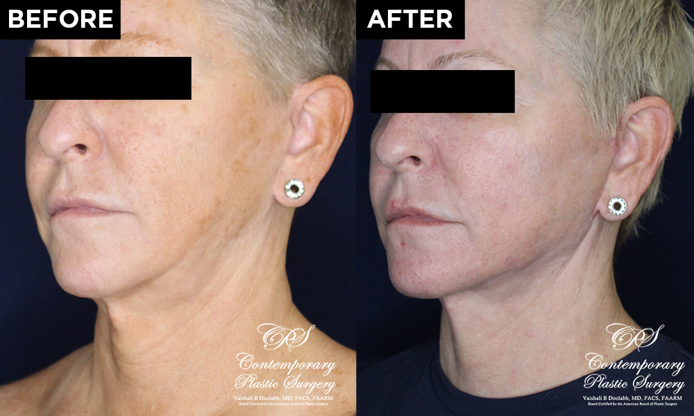 face and neck lift with CO2 laser