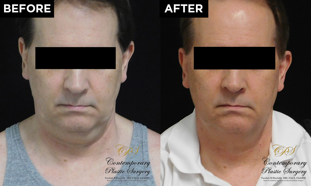 CoolSculpting patient results at Contemporary Plastic Surgery