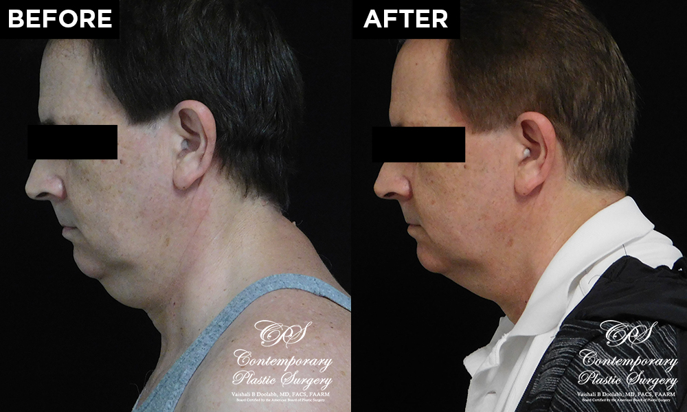 CoolSculpting patient results at Contemporary Plastic Surgery