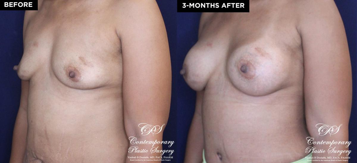 Patient 18489 breast augmentation before and after results at Contemporary Plastic Surgery
