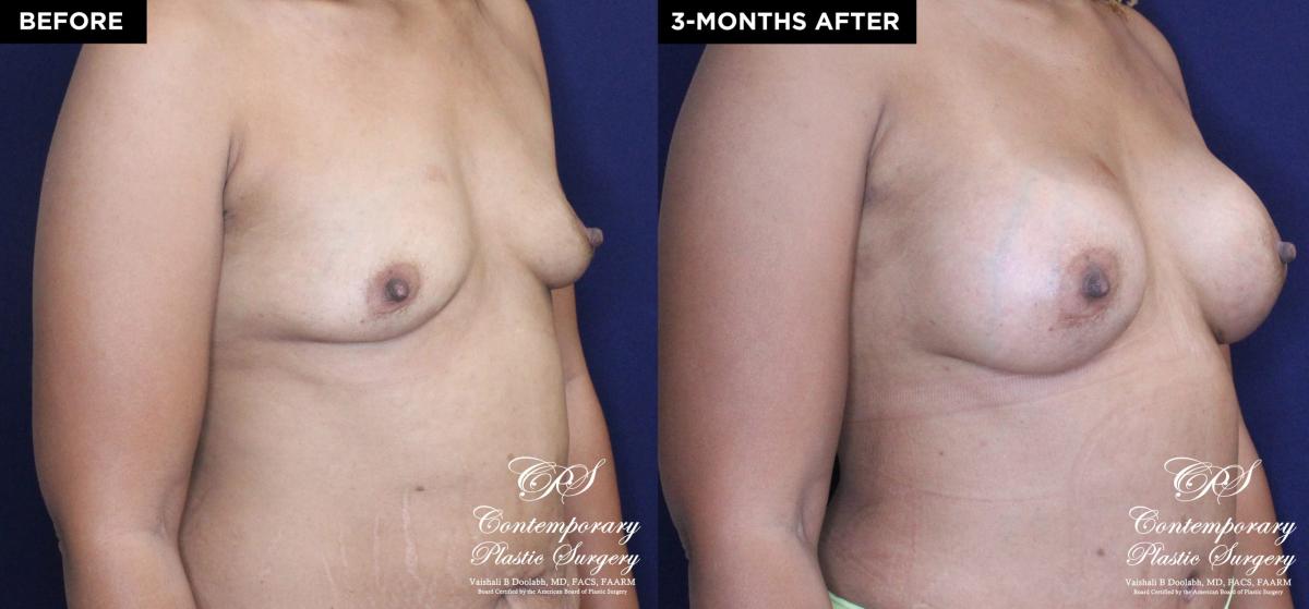Patient 18489 breast augmentation before and after results at Contemporary Plastic Surgery