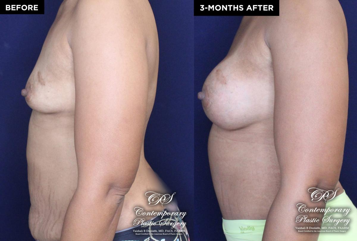 Patient 18489 breast augmentation before and after results at Contemporary Plastic Surgery